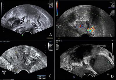 Evaluation of Uterosacral Ligament Involvement in Deep Endometriosis by Transvaginal Ultrasonography